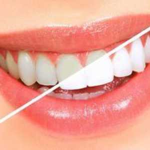 Dosky na bielenie zubov: indikácie a kontraindikácie