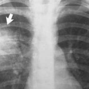 Pneumónia na RTG: príznaky ochorenia na röntgenových lúčoch