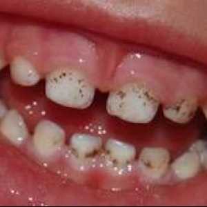 Prečo sa na zuboch objavujú čierne škvrny a ako sa môžu liečiť?