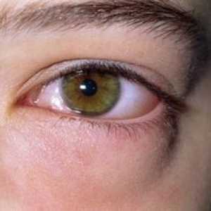 Vedľa oka sa objavil nepríjemný opuch: príčiny