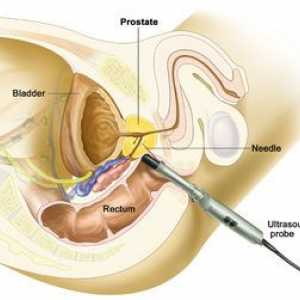 Príprava na hypertyroidizmus prostaty a ako analyzovať