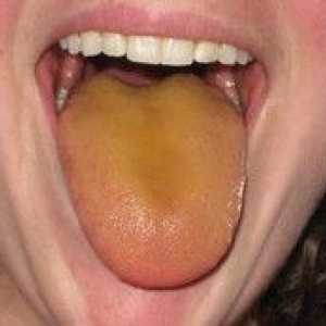 Na aké ochorenia sa na jazyku nachádza žltkastá farba