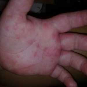 Príčiny svrbenia červených škvŕn na ruke