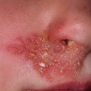 Príčiny a liečba herpesu na tvári