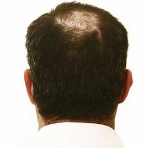 Príčiny a liečba plešatosti u mužov