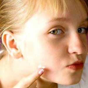 Príčiny a liečba akné na tvárach žien