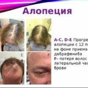 Príčiny alopécie (alopécia) a liečba