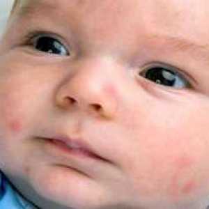 Príčiny výskytu červených škvŕn na tvári dieťaťa