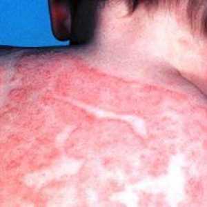 Príčiny, symptómy a liečba atopickej dermatitídy