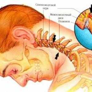 Známky a symptómy pri cervikálnej osteochondróze