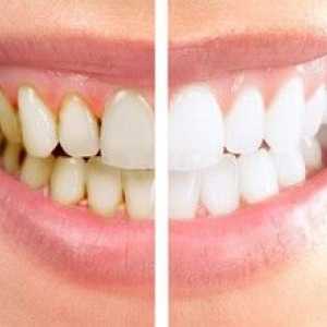 Profesionálne čistenie zubov v zubnom lekárstve: typy a popis