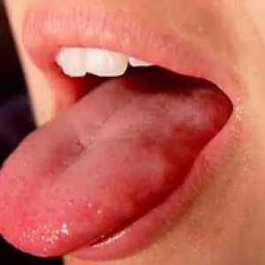 Pimples v jazyku: Čo ak sa objavili blízko krku?