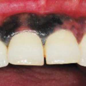 Rakovina ústnej dutiny: príčiny, symptómy, liečba a prevencia