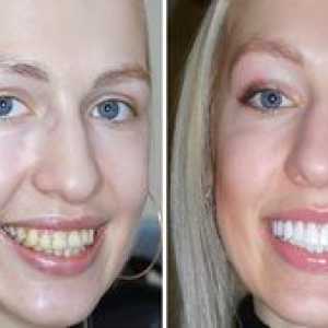 Obnova zubov: hlavné typy a koľko to bude stáť