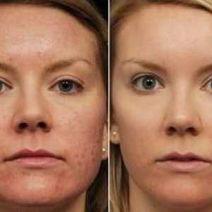 Retinoický peeling: moderné ošetrenie tváre