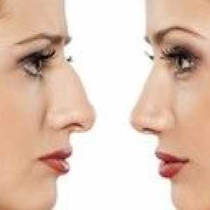 Operácia nosa: znaky plastickej chirurgie na nos