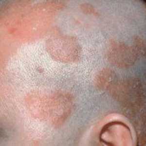Seboroická dermatitída pokožky hlavy: liečba a fotografie