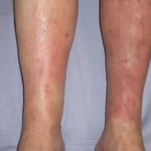 Príznaky a liečba dermatitídy na nohách, foto