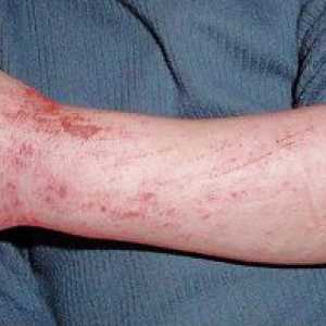 Príznaky a liečba dermatitídy u dospelých, foto