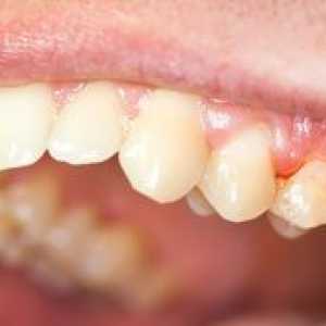 Symptómy a liečba chronickej parodontitídy