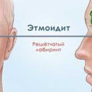 Príznaky a liečba etmoiditídy a antritis
