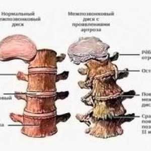 Symptómy a liečba osteochondrózy bedrovej chrbtice