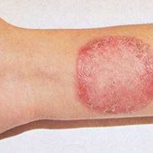Symptómy mykózy kože a liečba tejto choroby