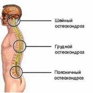Symptómy osteochondrózy krčnej a hrudnej chrbtice