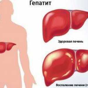 Koľko rokov môže človek žiť, keď je chronická hepatitída