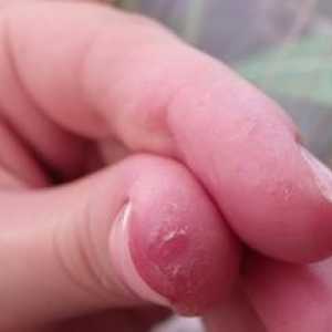 Koža sa odlupuje na prstoch: prečo sa to deje