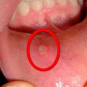 Stafylokoky v ústach: príznaky, spôsoby liečby, fotografie