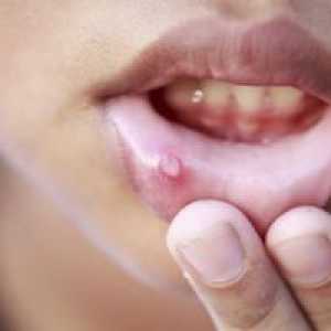 Stomatitída v ústach: kvôli tomu, čo sa stane a ako sa má liečiť