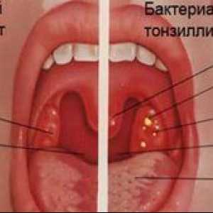 Tonzilitída: príznaky, príznaky, liečba
