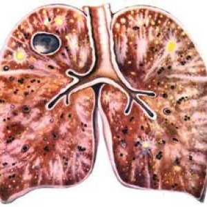 Tuberkulóza: spôsob prenosu, prenosové cesty a príznaky