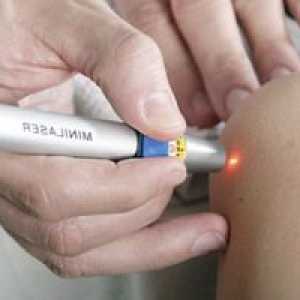 Laserové odstránenie papilómov: výhody, účinky a spätná väzba