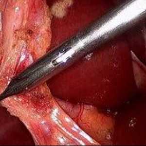 Odstránenie žlčníka: video operácia laparoskopia