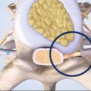 Impakcia nervov v bedrovej chrbtici a liečba