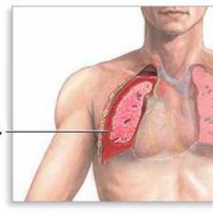 Voda v pľúcach: príčiny, dôsledky, liečba