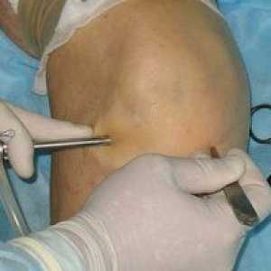 Obnova po operácii artroskopie kolenného kĺbu: recenzie