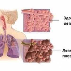 Všetko o pľúcnej fibróze: ako liečiť fibrózne zmeny v pľúcach