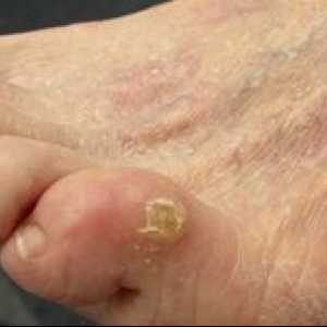 Choroby chodidiel na nohách: ako vyliečiť suché mozoly