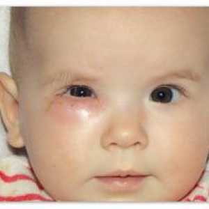Zastrešenie slzných kanálov u novorodencov: príčiny a liečba