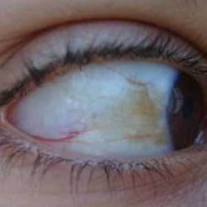 Žlté škvrny v oku: príčiny vzhľadu a liečby