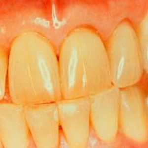 Žlté zuby: príčiny, spôsoby bielenia, prevencia