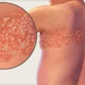 Zoznámenie sa s herpes zoster: príznaky a liečba