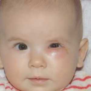Skúmanie slzného kanálika u novorodencov